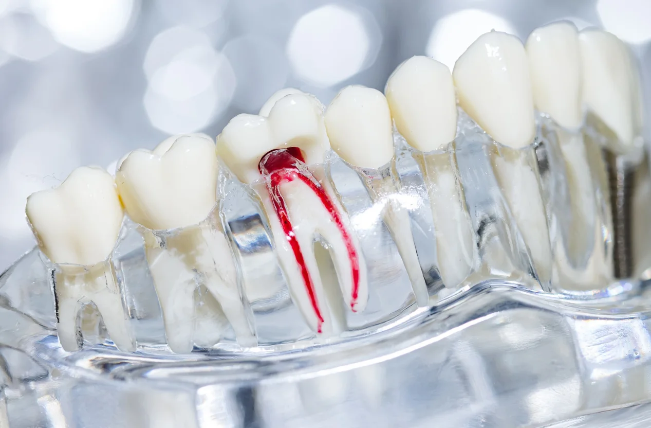 Root Canal Treatment Croydon General Dentistry Private Patient Appointments Available at Smile 4 U Dental Practice